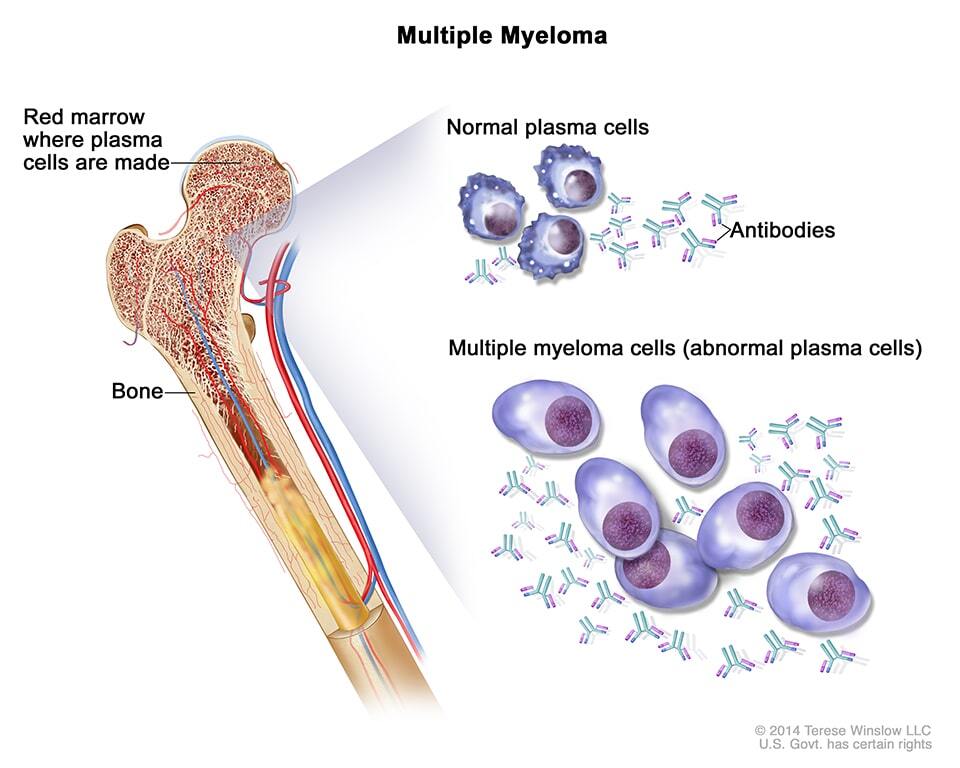 multiple_myeloma_india